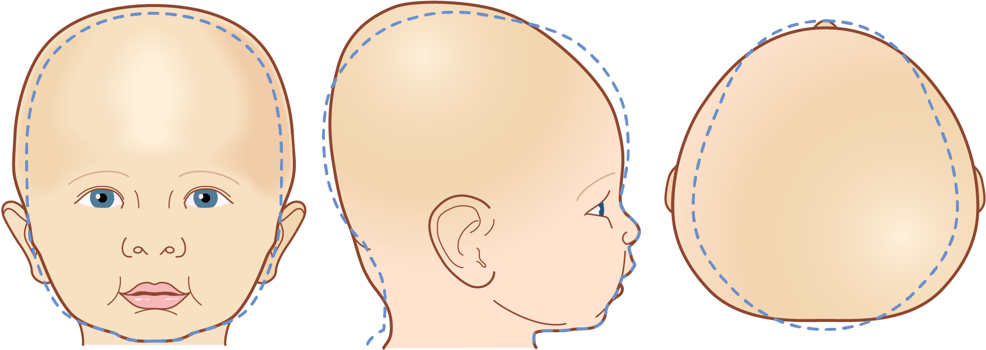 Brachycephaly