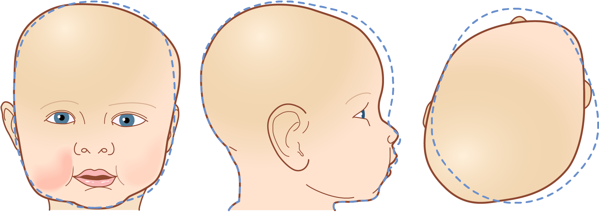 Plagiocephaly